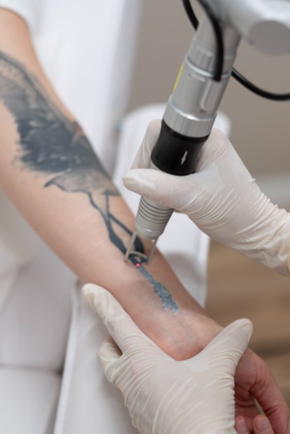 Tattooentfernung